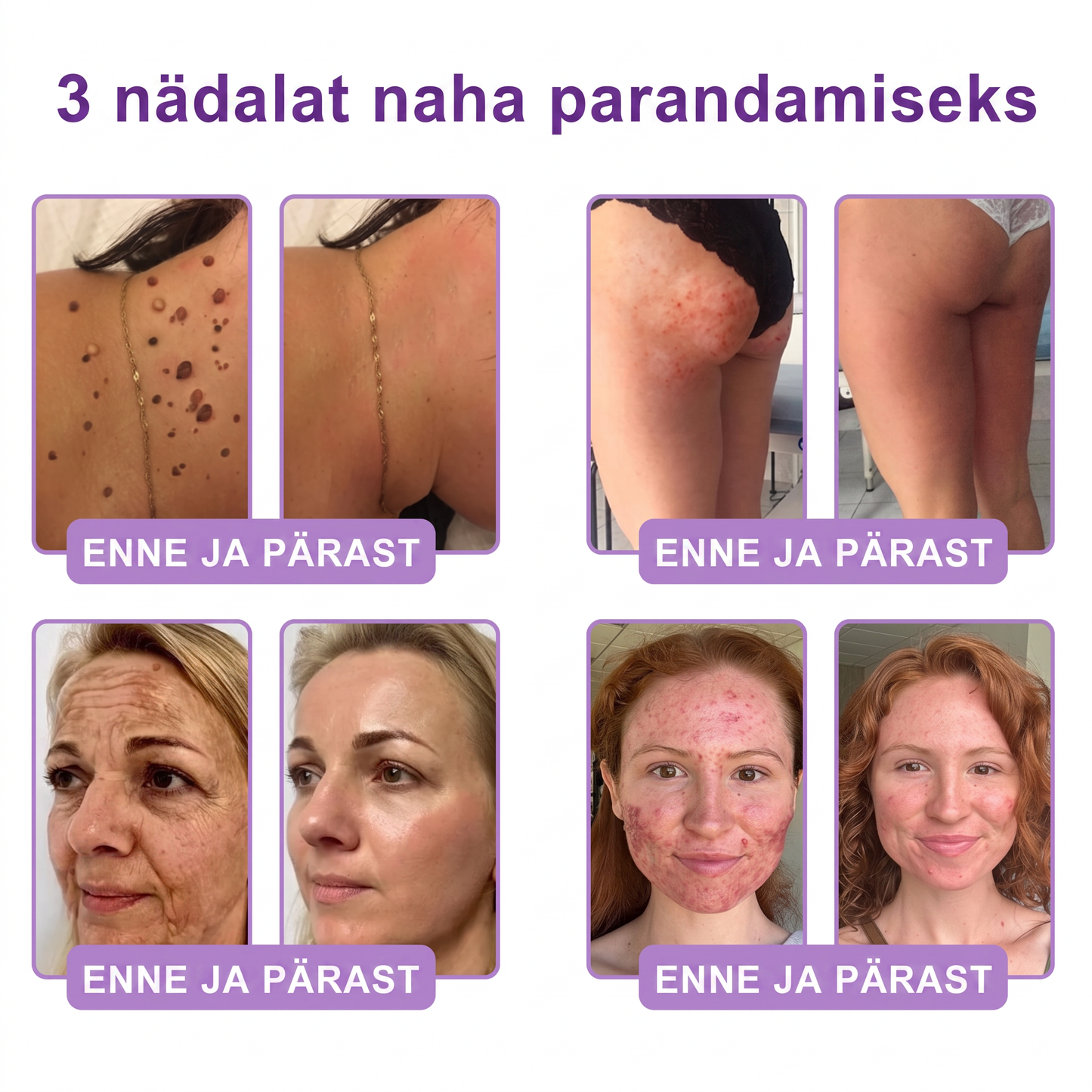 🇪🇪 Dermatoloogide lemmik🥦 | 🌥️Vitalisys® PDRN multi-peptiid kehamassaažikreem – Vananemisvastane, niisutav, pinguldav, taastav, siluv, akne ja plekkide eemaldamiseks, soolatüügaste ja sünnimärkide eemaldamiseks, psoriaasi leevendamiseks.❤️