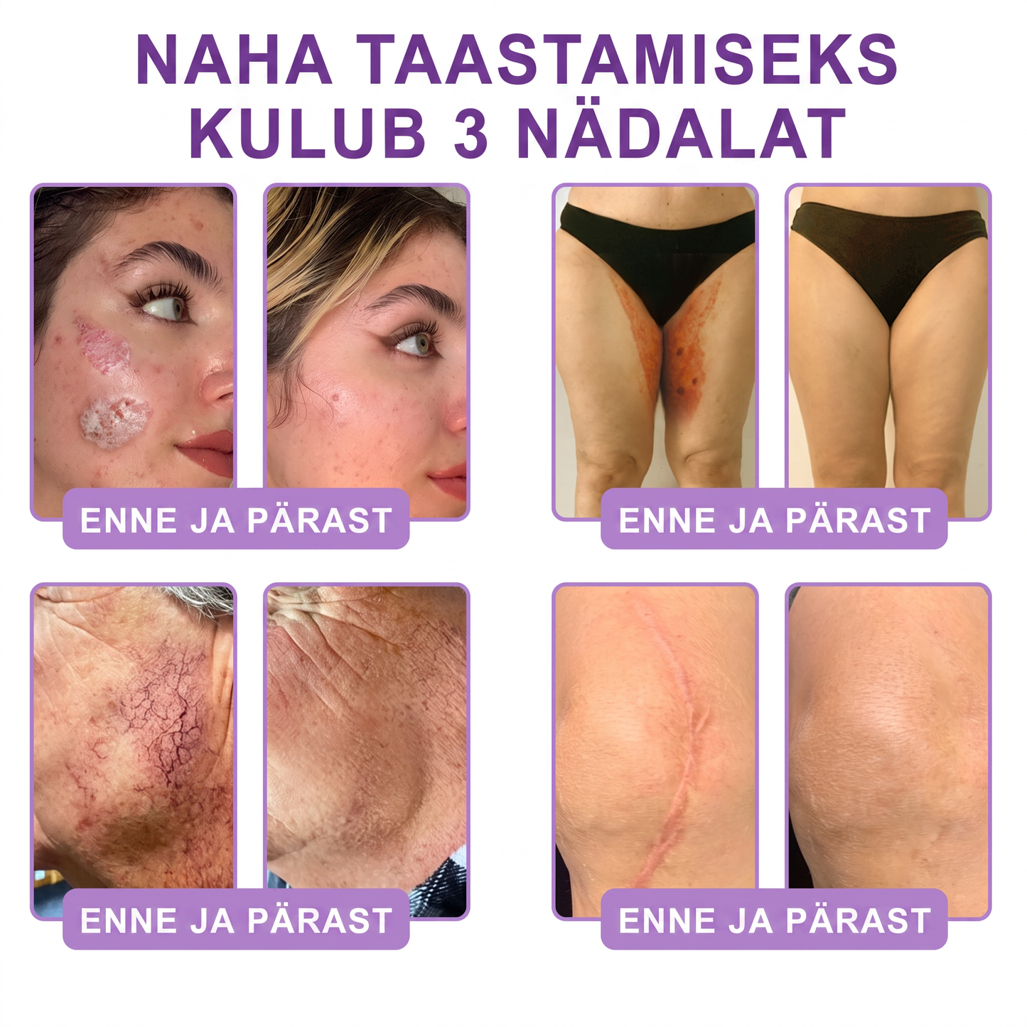 🇪🇪 Dermatoloogide lemmik🥦 | 🌥️Vitalisys® PDRN multi-peptiid kehamassaažikreem – Vananemisvastane, niisutav, pinguldav, taastav, siluv, akne ja plekkide eemaldamiseks, soolatüügaste ja sünnimärkide eemaldamiseks, psoriaasi leevendamiseks.❤️